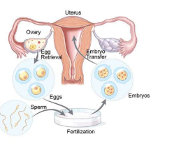 Method of In vitro fertilization