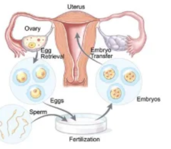 Method of in vitro fertilization