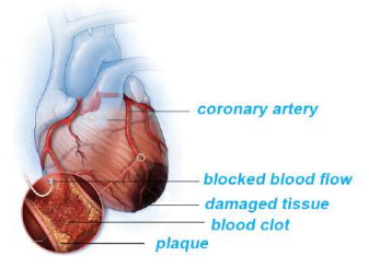 Condition Of HEART ATTACK