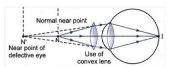 Correction of longsightedness